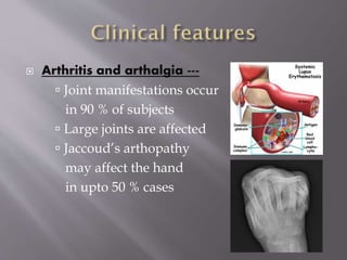  Arthritis and arthalgia ---
 Joint manifestations occur
in 90 % of subjects
 Large joints are affected
 Jaccoud’s arthopathy
may affect the hand
in upto 50 % cases
 