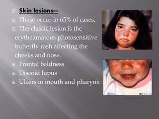  Skin lesions—
 These occur in 65% of cases.
 The classic lesion is the
erytheamatous photosensitive
butterfly rash affecting the
cheeks and nose.
 Frontal baldness
 Discoid lupus
 Ulcers in mouth and pharynx
 