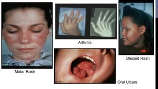Lupus Rash Distribution Systemic lupus erythematosis | PPTX