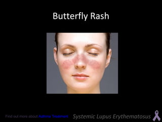 Systemic Lupus Erythematosus | PPT