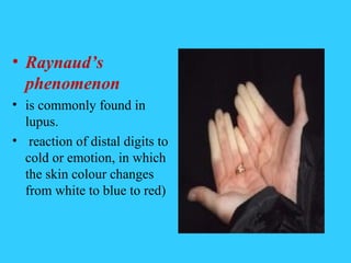 • Raynaud’s
  phenomenon
• is commonly found in
  lupus.
• reaction of distal digits to
  cold or emotion, in which
  the skin colour changes
  from white to blue to red)
 