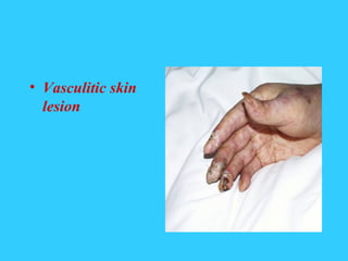 • Vasculitic skin
  lesion
 