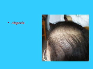 • Alopecia
 