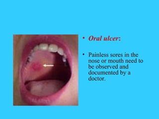 • Oral ulcer:

• Painless sores in the
  nose or mouth need to
  be observed and
  documented by a
  doctor.
 