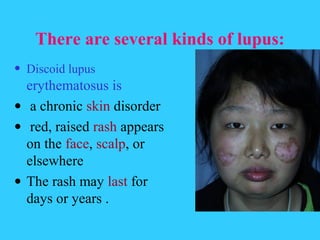 There are several kinds of lupus:
• Discoid lupus
  erythematosus is
• a chronic skin disorder
• red, raised rash appears
  on the face, scalp, or
  elsewhere
• The rash may last for
  days or years .
 