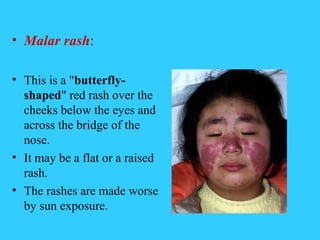 • Malar rash:

• This is a "butterfly-
  shaped" red rash over the
  cheeks below the eyes and
  across the bridge of the
...