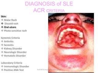 Systemic lupus erythematosus | PPTX