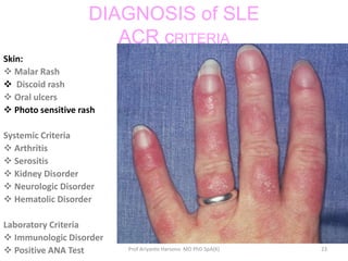 Systemic lupus erythematosus | PPTX