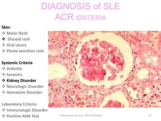 Systemic lupus erythematosus | PPTX