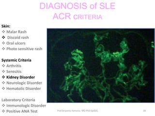 Systemic lupus erythematosus | PPTX