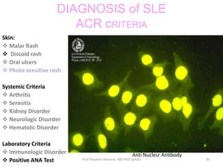 Systemic lupus erythematosus | PPTX