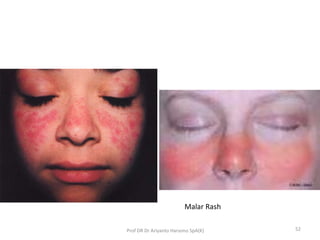 Systemic lupus erythematosus | PPTX