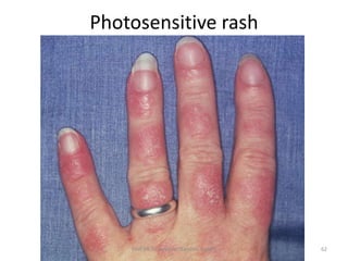 Photosensitive Rash Detatchment Systemic lupus erythematosus | PPTX