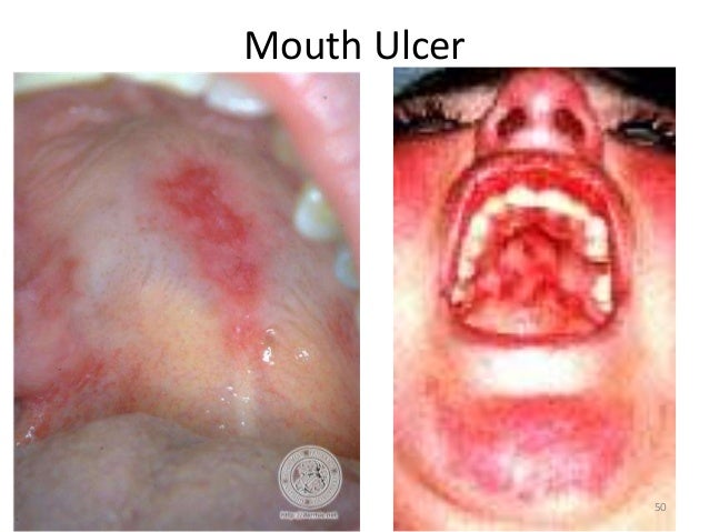 Systemic Lupus Erythematosus 2 Picture Image on ...
