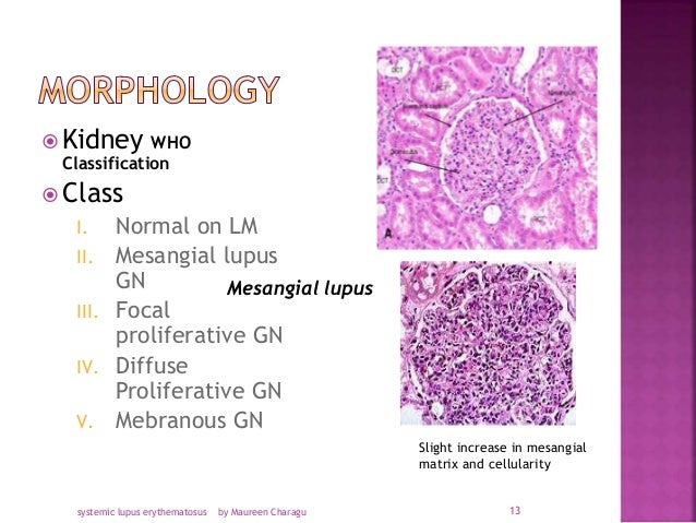 Systemic lupus erythematosus.