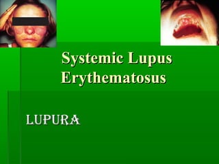 Systemic LupusSystemic Lupus
ErythematosusErythematosus
LupuraLupura
 