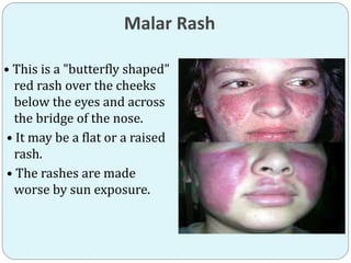 Malar Rash
• This is a "butterfly shaped"
red rash over the cheeks
below the eyes and across
the bridge of the nose.
• It may be a flat or a raised
rash.
• The rashes are made
worse by sun exposure.
 