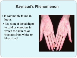Raynaud’s Phenomenon
• Is commonly found in
lupus.
• Reaction of distal digits
to cold or emotion, in
which the skin color
changes from white to
blue to red.
 