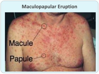 Maculopapular Eruption
 