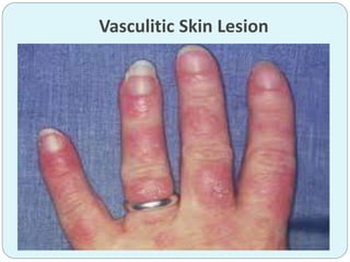 Vasculitic Skin Lesion
 