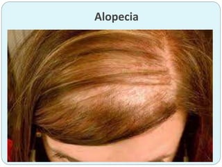 Alopecia
 