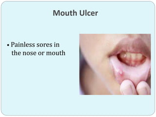 Mouth Ulcer
• Painless sores in
the nose or mouth
 