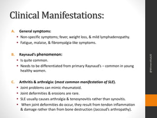 Systemic lupus erythematosus