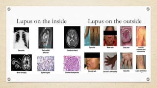 Lupus on the inside Lupus on the outside
 