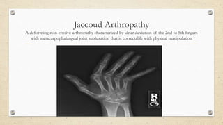 Jaccoud Arthropathy
A deforming non-erosive arthropathy characterized by ulnar deviation of the 2nd to 5th fingers
with metacarpophalangeal joint subluxation that is correctable with physical manipulation
 