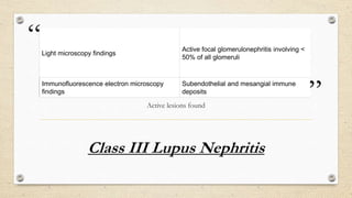 “
”
Class III Lupus Nephritis
Active lesions found
Light microscopy findings
Active focal glomerulonephritis involving <
50% of all glomeruli
Immunofluorescence electron microscopy
findings
Subendothelial and mesangial immune
deposits
 