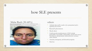 how SLE presents
Malar Rash (30-40%) others
• Arthritis (Jaccoud's): tends to be symmetrical and is
typically non-erosive
• Raynaud's phenomenon
• Mouth ulcers
• Cardiovascular manifestations of SLE include
pericarditis, myocarditis, endocarditis, arterial and venous
thrombosis, and premature atherosclerotic coronary
artery disease
• Anaemia, leukopenia, and thrombocytopenia
• Hair loss
 