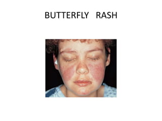 BUTTERFLY RASH
 