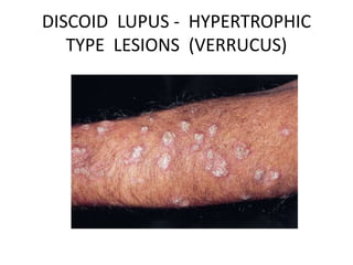 DISCOID LUPUS - HYPERTROPHIC
TYPE LESIONS (VERRUCUS)
 