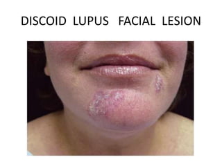DISCOID LUPUS FACIAL LESION
 