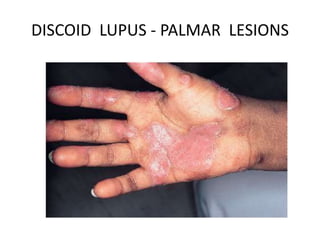 DISCOID LUPUS - PALMAR LESIONS
 