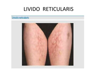 LIVIDO RETICULARIS
 