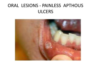 ORAL LESIONS - PAINLESS APTHOUS
ULCERS
 