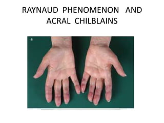 RAYNAUD PHENOMENON AND
ACRAL CHILBLAINS
 