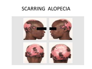SCARRING ALOPECIA
 