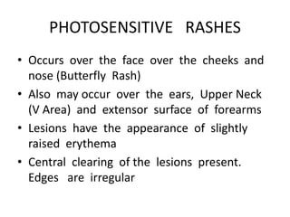 PHOTOSENSITIVE RASHES
• Occurs over the face over the cheeks and
nose (Butterfly Rash)
• Also may occur over the ears, Upper Neck
(V Area) and extensor surface of forearms
• Lesions have the appearance of slightly
raised erythema
• Central clearing of the lesions present.
Edges are irregular
 