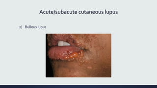Acute/subacute cutaneous lupus
2) Bullous lupus
 