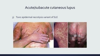Acute/subacute cutaneous lupus
3) Toxic epidermal necrolysis variant of SLE
 