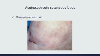 Acute/subacute cutaneous lupus
4) Maculopapular lupus rash
 