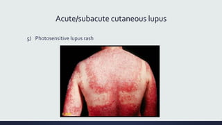Acute/subacute cutaneous lupus
5) Photosensitive lupus rash
 
