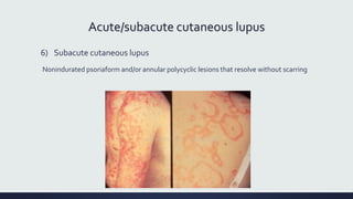 Acute/subacute cutaneous lupus
6) Subacute cutaneous lupus
Nonindurated psoriaform and/or annular polycyclic lesions that resolve without scarring
 
