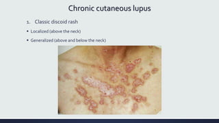 Chronic cutaneous lupus
1. Classic discoid rash
 Localized (above the neck)
 Generalized (above and below the neck)
 
