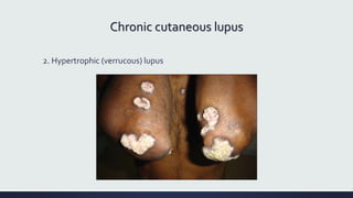 Chronic cutaneous lupus
2. Hypertrophic (verrucous) lupus
 