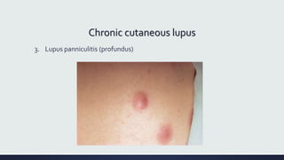 Chronic cutaneous lupus
3. Lupus panniculitis (profundus)
 