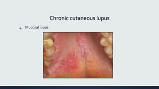 Chronic cutaneous lupus
4. Mucosal lupus
 