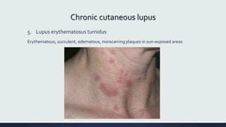 Chronic cutaneous lupus
5. Lupus erythematosus tumidus
Erythematous, succulent, edematous, nonscarring plaques in sun-exposed areas
 